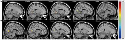 Brain Functional and Structural Alterations in Women With Bipolar Disorder and Suicidality